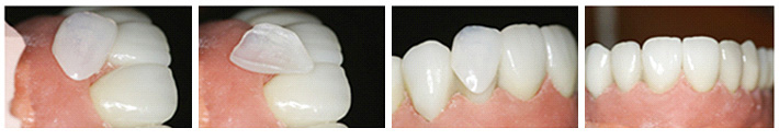 پروتزهای دندان 2