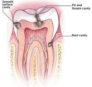 درمان پوسیدگی دندان 1